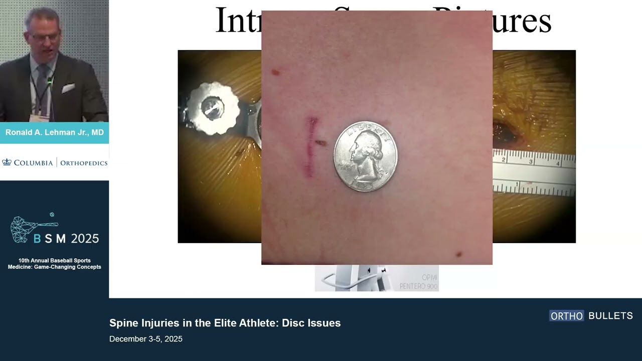 Spine Injuries in the Elite Athlete_Disc Issues_Ronald Lehman MD