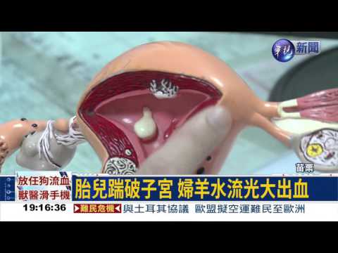 胎兒踢破子宮 緊急剖腹保命