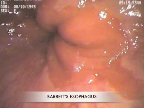Ezofagoskopia przeznosowa - przełyk Barretta