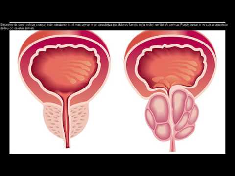 Prostatitis gondolatok