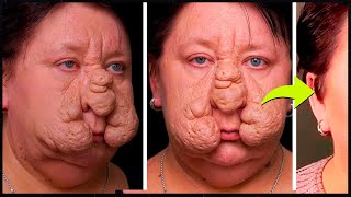 Download lagu Remember the WOMAN who became DEFORMED after 'POKING' her FACE? She RECOVERED after PROCEDURES! mp3