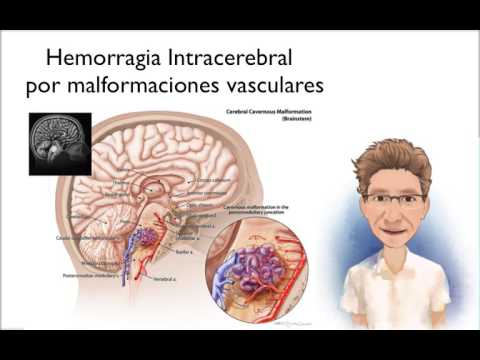 download lagu mp3 mp4 Angiopatia Amiloide Cerebrale, download lagu Angiopatia Amiloide Cerebrale gratis, unduh video klip Angiopatia Amiloide Cerebrale