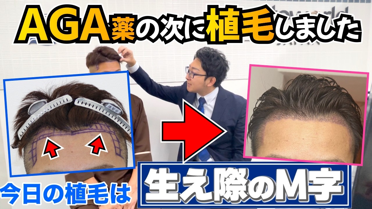 僕はAGA薬の次に植毛しました【東京植毛クリニック｜薄毛対策】