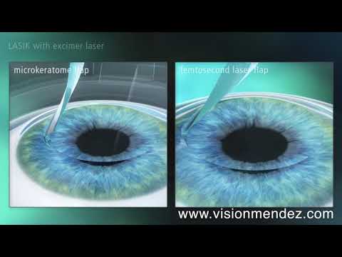 LASIK vs FEMTO-LASIK