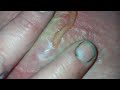 heroin abscess