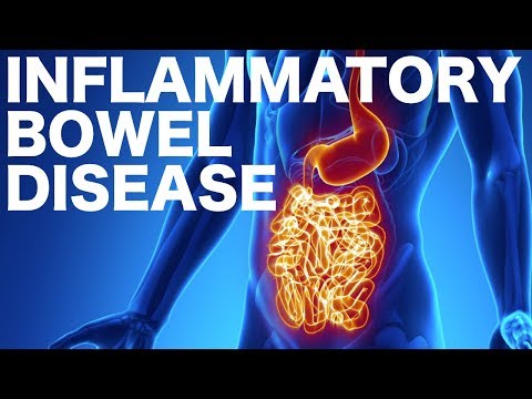 Crohn's vs. Ulcerative Colitis