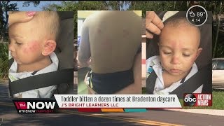 Toddler bitten over a dozen times at daycare