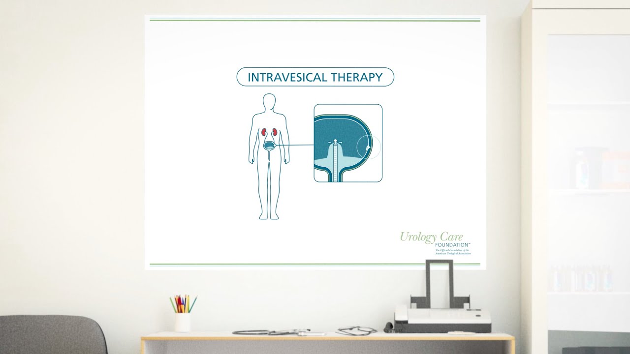 Bladder Cancer Treatment: Intravesical Therapy - Urology Care Foundation