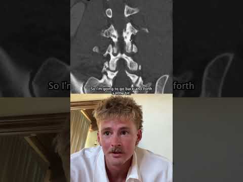 Broken back healed?! 🤯