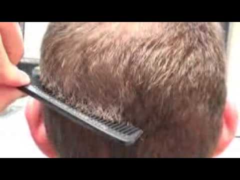 Alex's Undetectable Scar: 5 mo