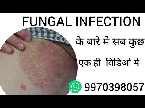 Unguento ng fungus ekzoderil analogues Halamang-singaw sa kuko ginagamot Domash