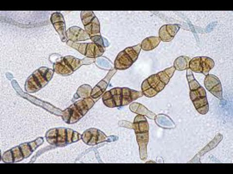 Hogyan kezelik a paraziták a pajzsmirigyet