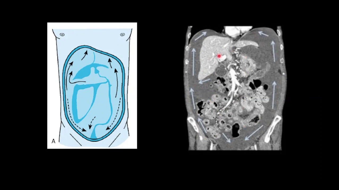 Anatomía Normal de la Cavidad Peritoneal-TC