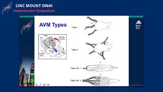 Embolization of AV Malformations: Tips and Tricks