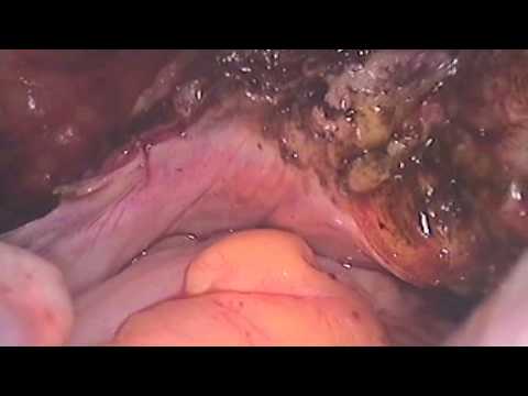 comment traiter un fibrome de 5 cm