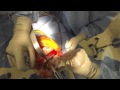 Knee replacement surgery (graphic)