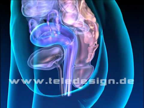 U 018 Gebärmutter Vorfall  - SD PAL/ U 018 Uterine prolapse  - SD PAL