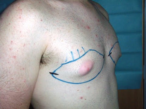 Εικόνα προεπισκόπησης βίντεο: Γυναικομαστία (ουδέτερη μικρογραφία)