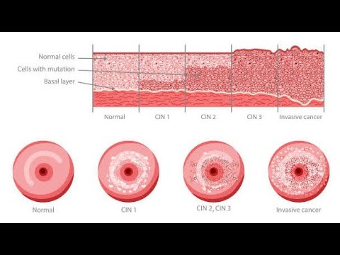 Low Grade Squamous Intraepithelial LesionLSIL And High Grade Squamous Intraepithelial LesionHSIL