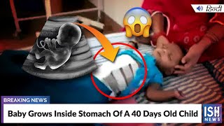 Baby Grows Inside Stomach Of A 40 Days Old Child