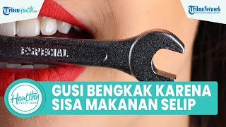 Penyebab Gusi Bengkak akibat Sisa Makanan Menyelip di Gigi, Begini Cara Atasinya
