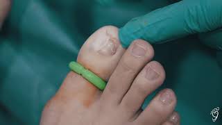 Cirugía definitiva de uña encarnada (incarnata). Técnica Láser en Clínica de los Podólogos. Madrid.