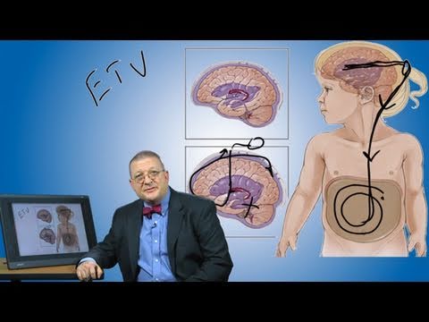 Hydrocephalus and its treatment | Boston Children’s Hospital