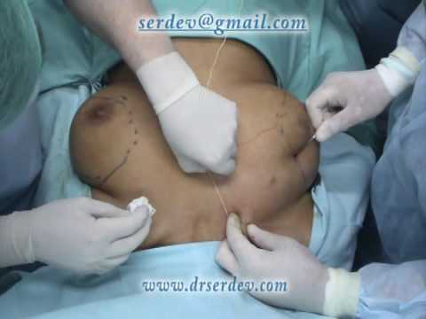 Breast lift to clavicle, Mastopexy by Serdev sutures in large breasts, no scars, no downtime