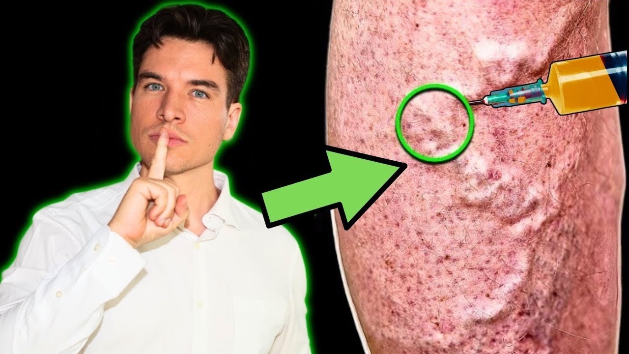 Inacreditável! 🤩 É um assassino de VARIZES nas pernas! Apaga as varizes como uma borracha!