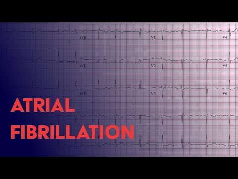Atrial Fibrillation (Afib) - EKG (ECG) Interpretation