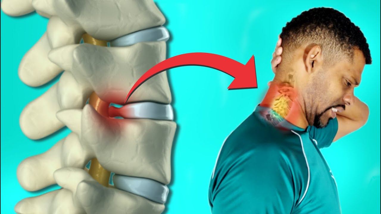 Hérnia de disco Cervical | Previna as CRISES com esses exercícios  -  Rodrigo Lopes fisioterapeuta