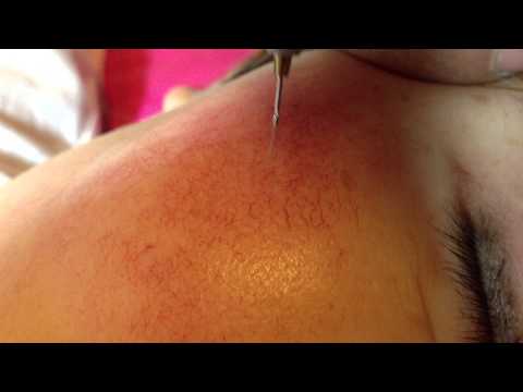 Red Vascular Vein Removal,Varicose Veins Removal,Laser Red Vein Removal