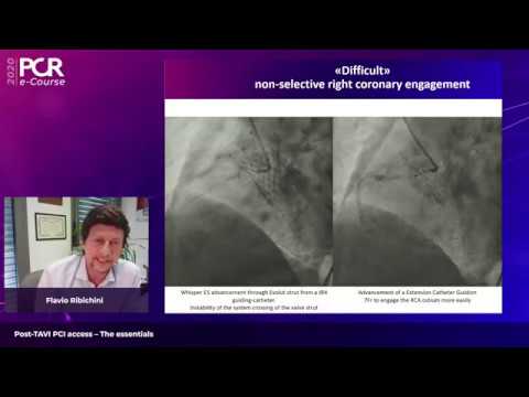 Tips and tricks to achieve PCI access after transcatheter aortic valve implantation – The essentials
