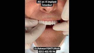 All on 4 implant ile sabit dişler. #zirkonyum #zirkonyumkaplama #impla