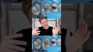 Flat Top Cusps, A good idea?  #dentaleducation #dentist #ripeglobal