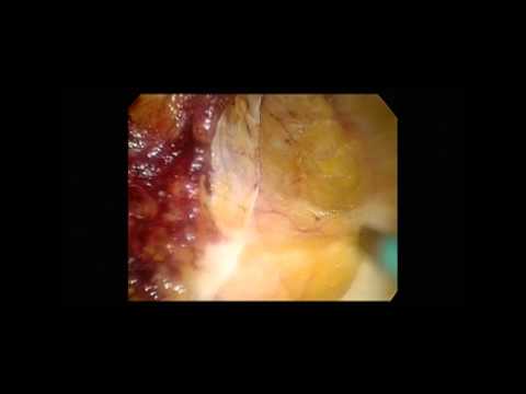 Endoscopic Subcutaneous Approach to Component Separation