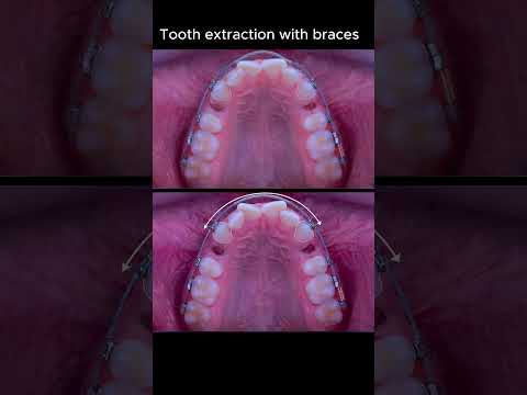 Don't worry about tooth extraction with braces #ardaarisan