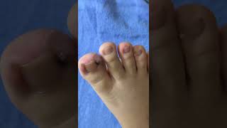 Ep_8288 Ingrown toenail removal 👣 หนูเป็นอีกครั้ง..เพราะดูแลแผลไม่ถูกวิธี 😄 (clip from Thailand)