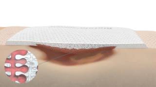 Product video: Biatain Silicone Foam Dressings, Square Shape - Sizes 3, 4, 5, 6, Inch (Each or Box of 10) - Coloplast