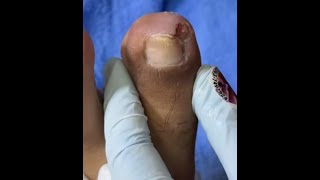 Ep_8163 Ingrown toenail removal 👣 เล็บฝังอยู่ข้างหน้า 😄 (clip from Thailand)