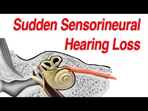 Sudden Sensorineural Hearing Loss: Diagnosis, Causes, and Treatment