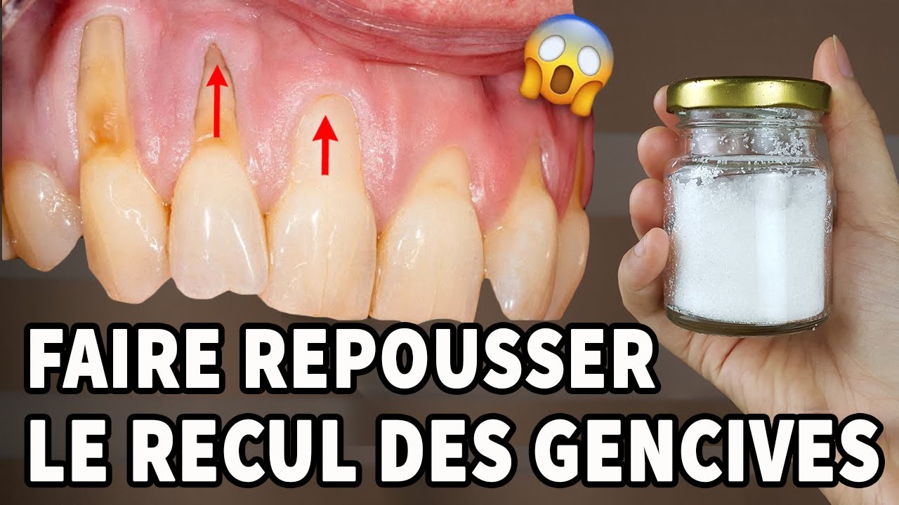 Incroyable! Il S’agit D’un Remède À La Maison Pour La Récession Gingivale