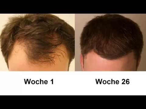 Was tun gegen Haarausfall oder Geheimratsecken? Meine Erfolgsgeschichte!