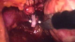 Laparoscopic distal pancreatectomy and splenectomy