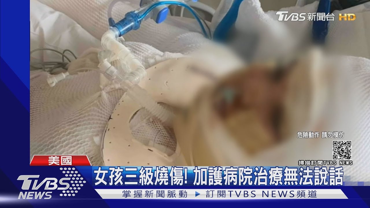 13歲女模仿「火焰挑戰」 滿身是火送醫