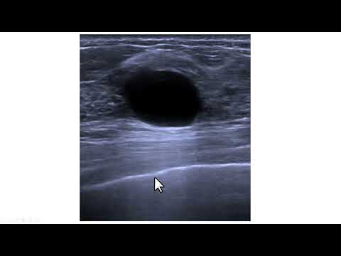 Reforço acústico posterior em um cisto mamário. Formação e significado clínico.