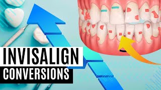 Mastering Invisalign Consultations | Top 5 Tips for Dentists