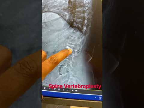 Thumbnail of video - Vertebroplasty in elderly 78 year lady: life changing procedure