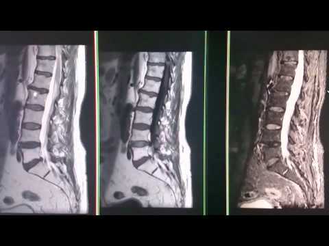 Desplazamiento conjunto en la columna cervical Dolor en el pecho y la espalda parte inferior del abdomen