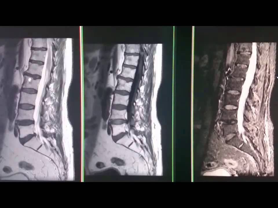 Resonancia magnetica de columna lumbar y columna dorsal